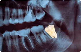 ODONTECTOMY 1
