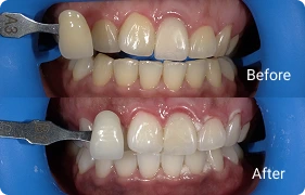 SIGNATURE DENTAL WHITENING