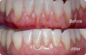 connective tissue graft