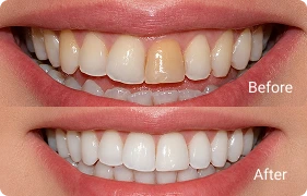 internal bleaching