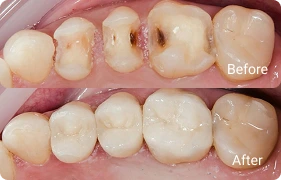 pulp capping