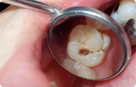 temporary dental filling